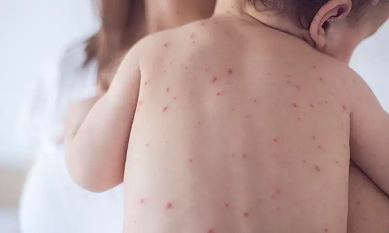 Larkana Reports Decline in Measles Cases as Health Experts Call for Expanded Vaccination Coverage